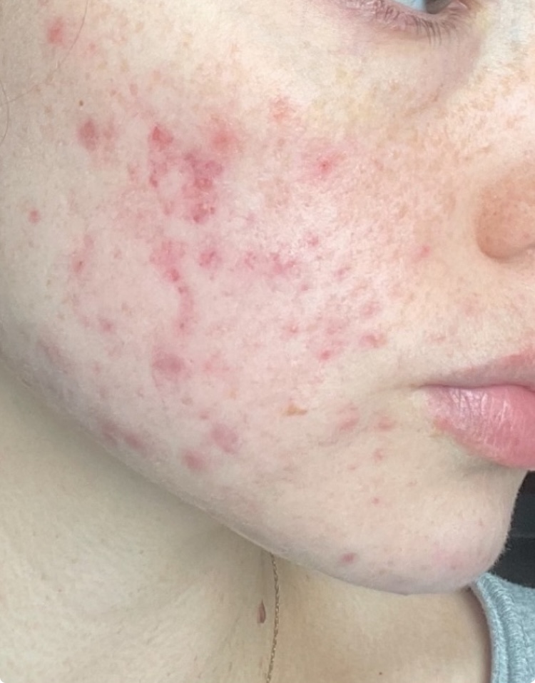 Acne on cheek