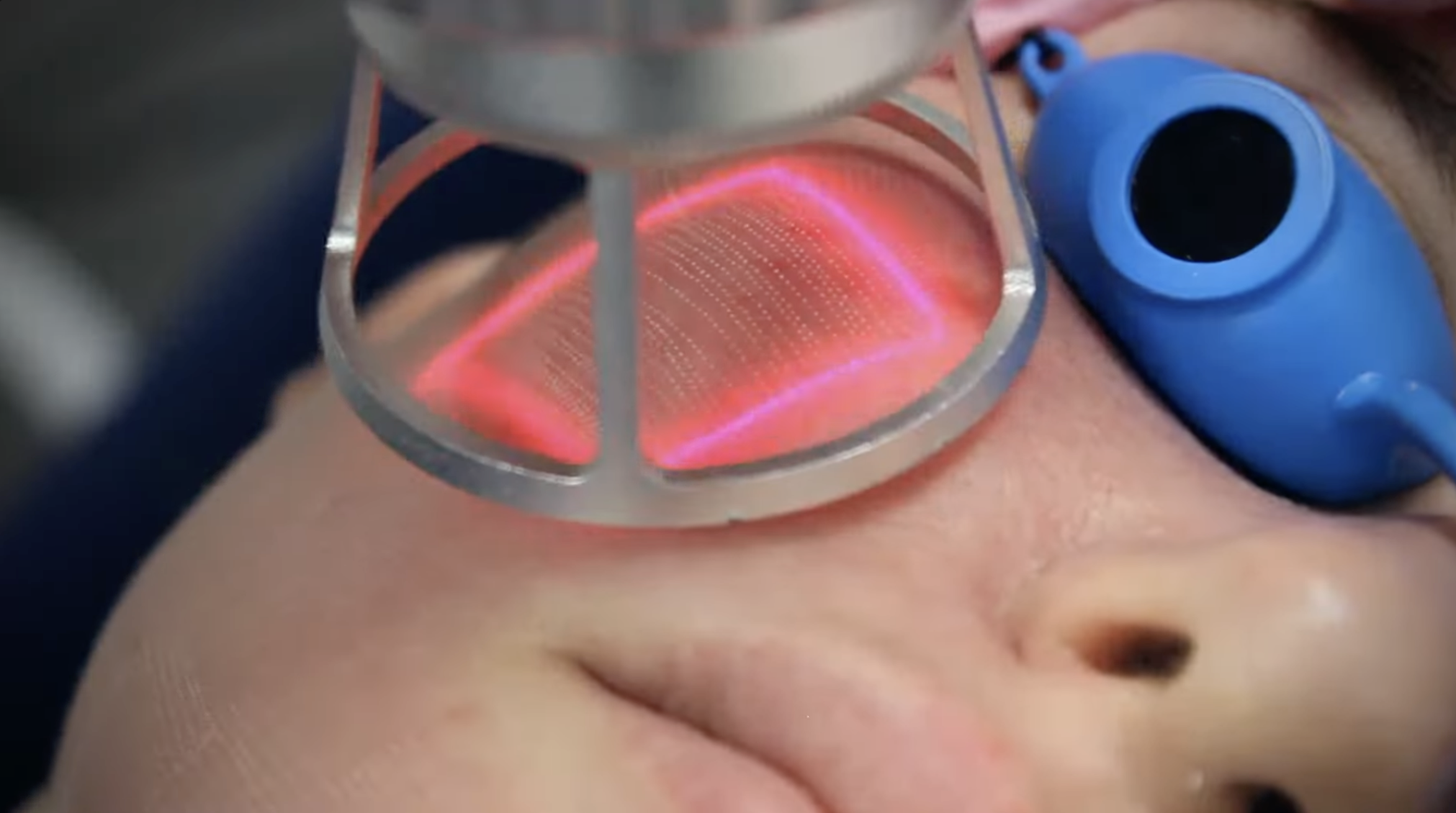 CO2 laser resurfacing treatment