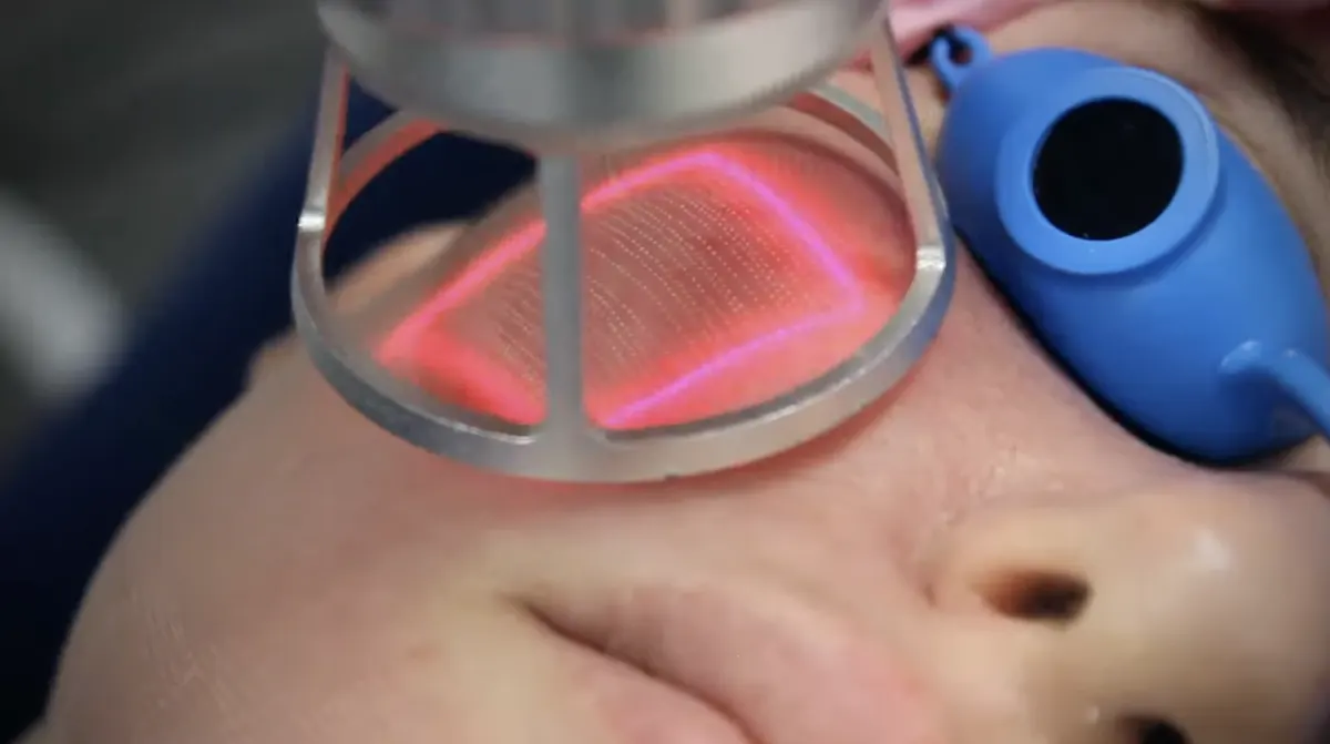 CO2 laser resurfacing treatment in Chicago