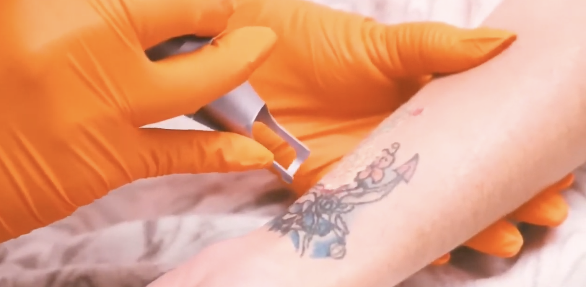 Pico laser tattoo removal treatment