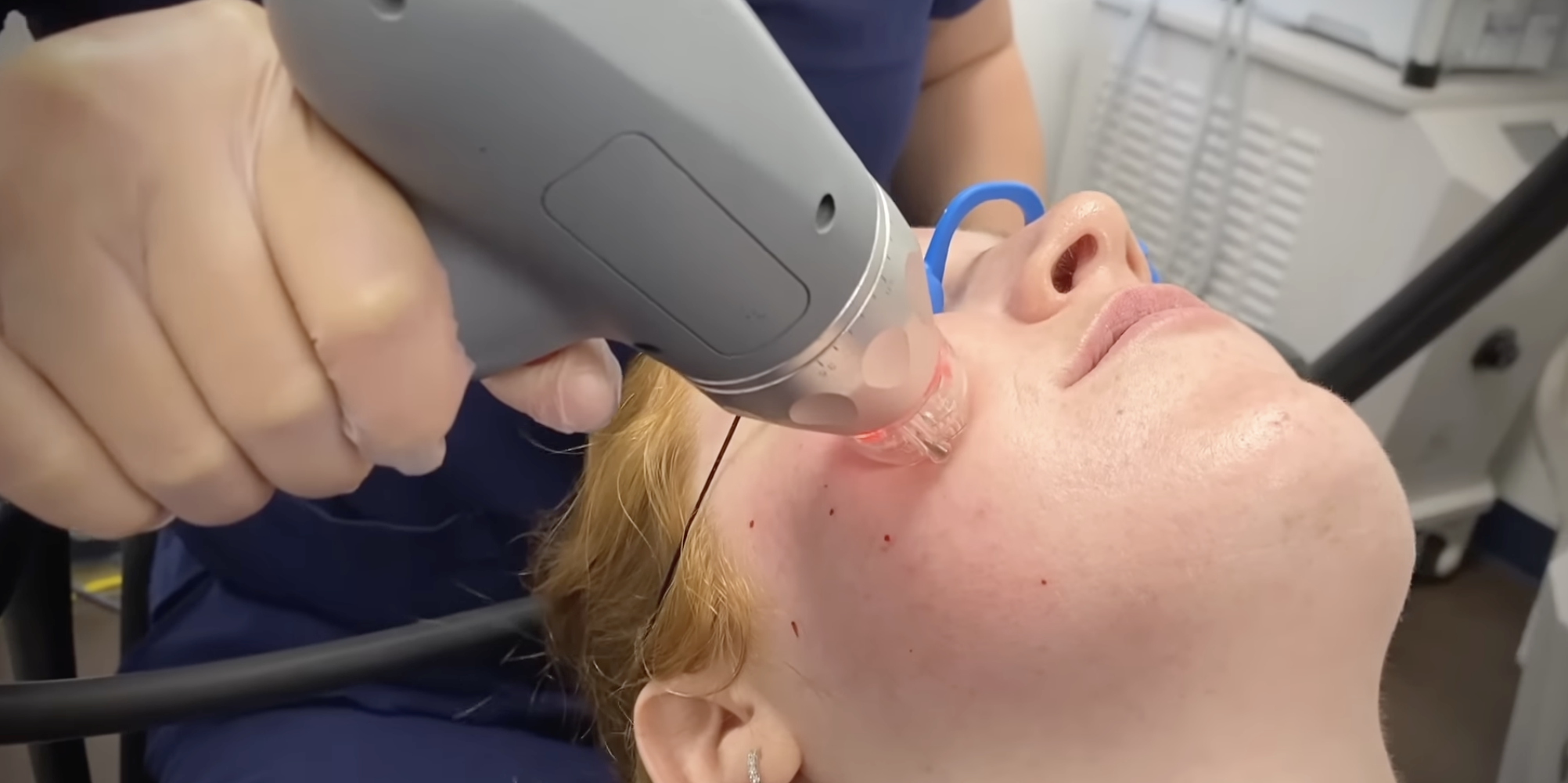 RF microneedling treatment