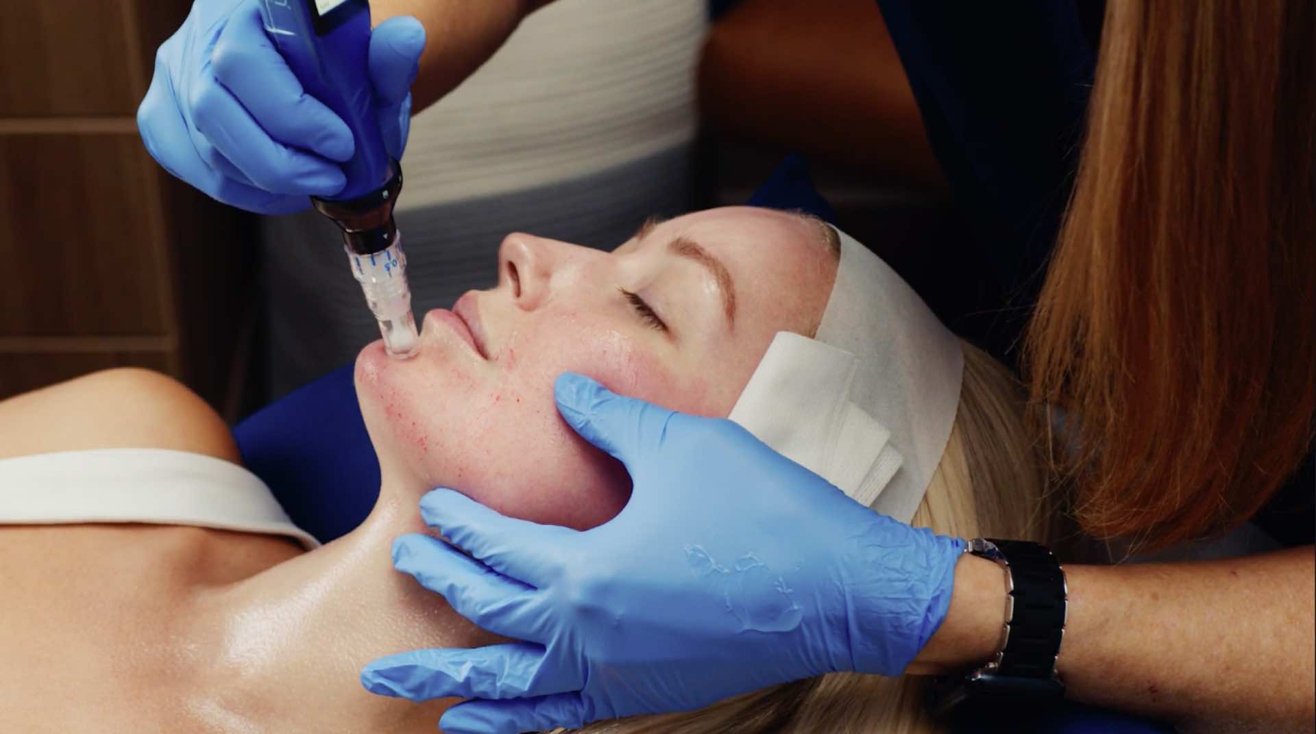 SkinPen microneedling treatment